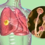 covid associated pulmonary aspergillosis 555