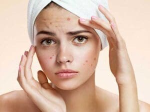 5134e7e2 pimples in your 20s 640x480 1