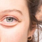 Bags Under Eyes 800x534 1