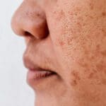 woman dark spots face e1652291872456