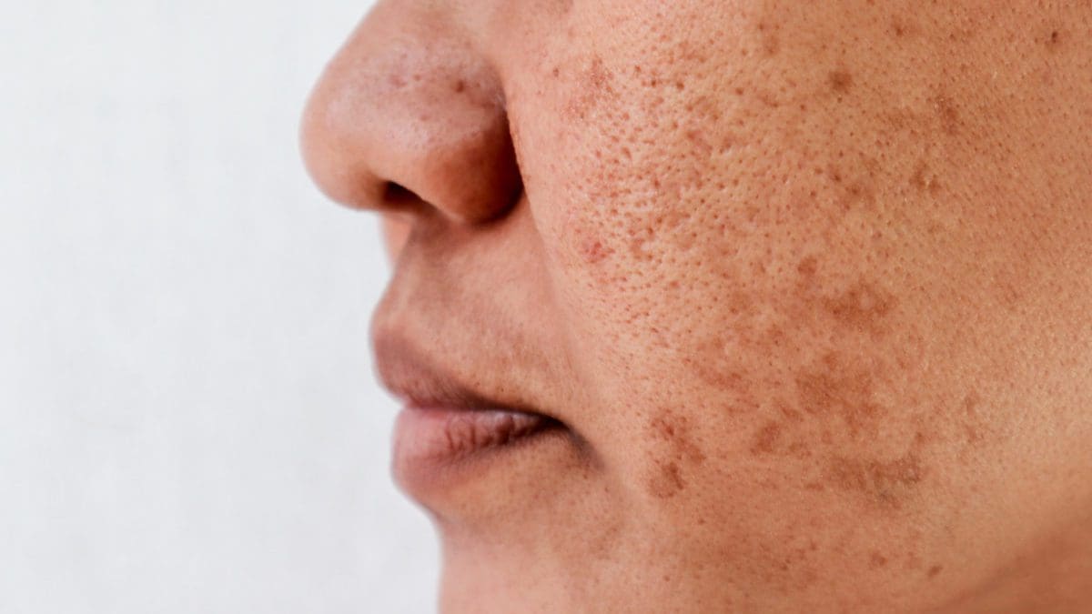 woman dark spots face e1652291872456