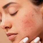 pixabay acne pimples 1200