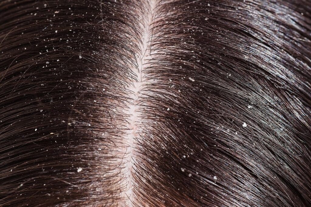 பொடுகு தொல்லை போக்க வேண்டுமா? இதனை போக்க சில டிப்ஸ் ! 3 Dandruff and dry scalp are different but need similar treatment 1