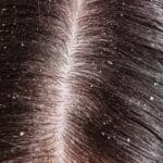 Dandruff and dry scalp are different but need similar treatment 1