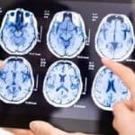 மூளையை உண்ணும் அமீபா! கேரளாவில் 15 வயது சிறுவன் உயிரிழப்பு