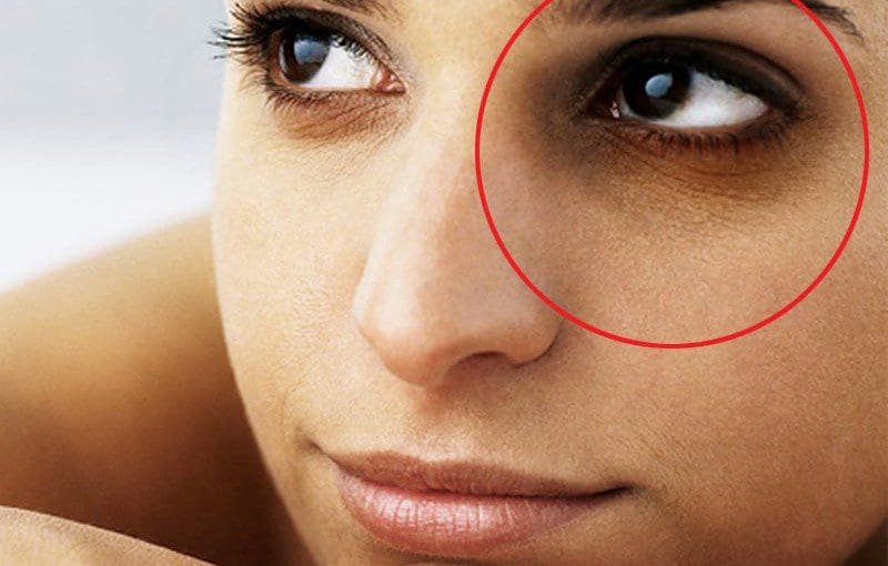 கண்களை சுற்றி கருவளையமா? இதனை போக்க இதோ சில டிப்ஸ்! 1 dark circles