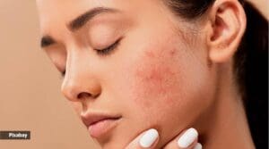pixabay acne pimples 1200
