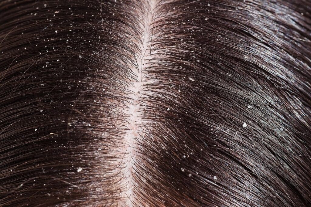 Dandruff and dry scalp are different but need similar treatment 1