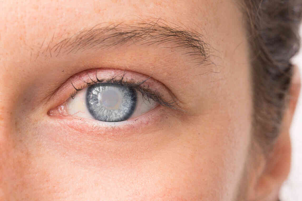 அறிகுறிகள் இன்றி அதிகரிக்கும் குருட்டுத்தன்மை! 1 cataract